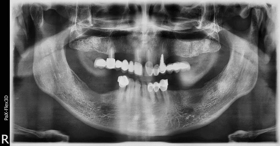Implantes dentales