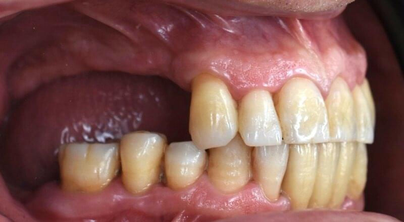 Carillas dentales