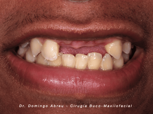 blanqueamiento dental